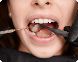 Chipped and Broken Teeth